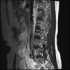 LUMBAR SPINE WITHOUT CONTRAST 0014.jpg