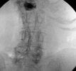 2.CaudalTilt.GetPedicle.jpg