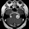 meningititis