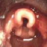 Direct Laryngoscopy