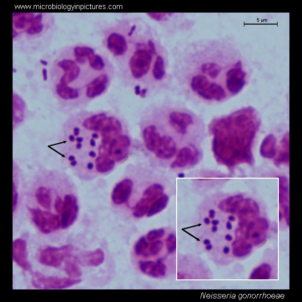 Chlamydia trachomatis neisseria gonorrhoeae. Гонорея мазок микроскопия.