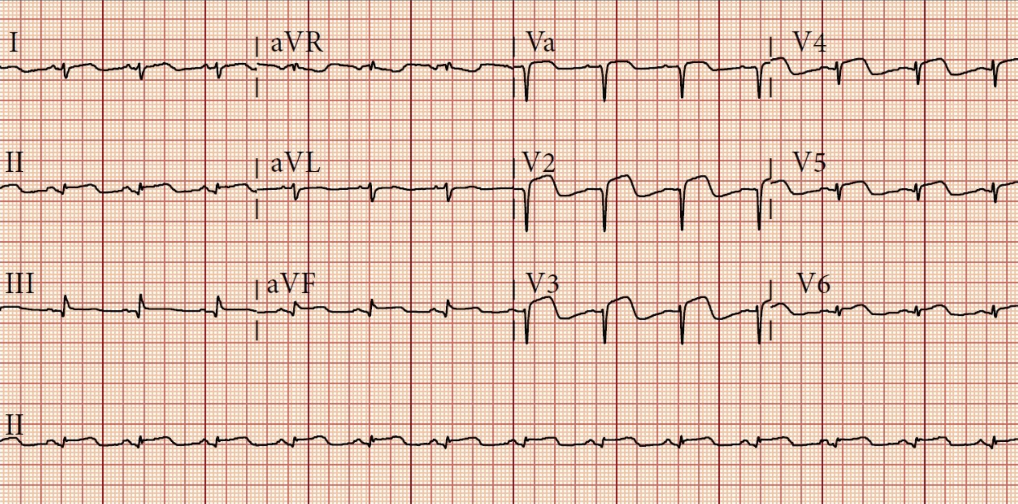 EKG_2_12.jpg