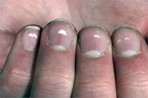 M-NA0306disease-pict1-LR.jpg