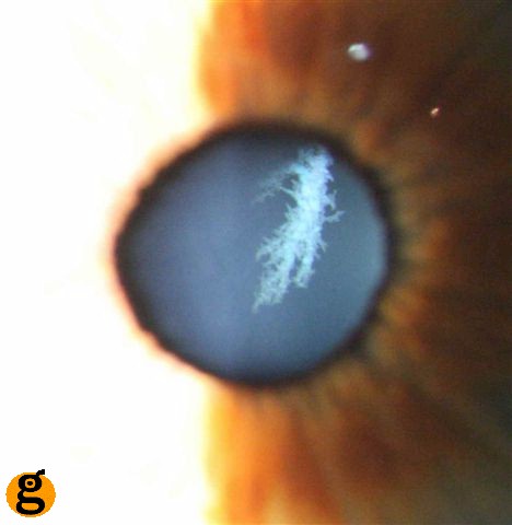 dendritic+cataract.jpg