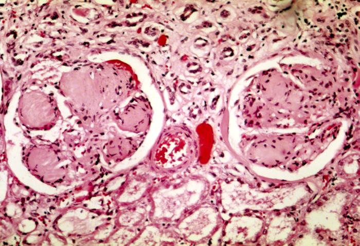 Nodular_glomerulosclerosis.jpeg