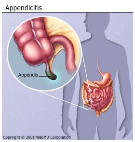 digestive_diseases_appendicitis_appendix.jpg