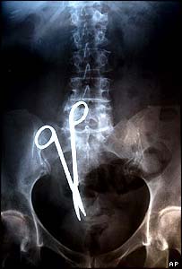 _40064245_scissors_xray203.jpg