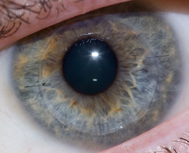 742px-Cornea_Transplant.jpg