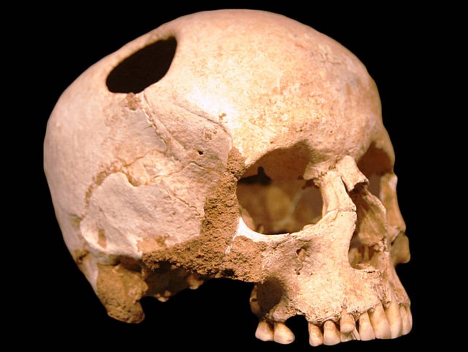trepannated-skull-neolithic.jpg