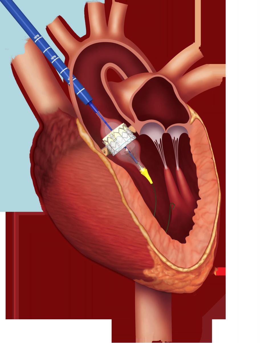 Митральный клапан после операции. Операция на сердце аортальный клапан. Искусственный митральный клапан сердца. Сердце операция митральный клапан. 3 Катетерная баллонная аортальная вальвулопластика.
