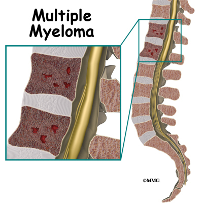 spinal_tumor_myeloma01.jpg
