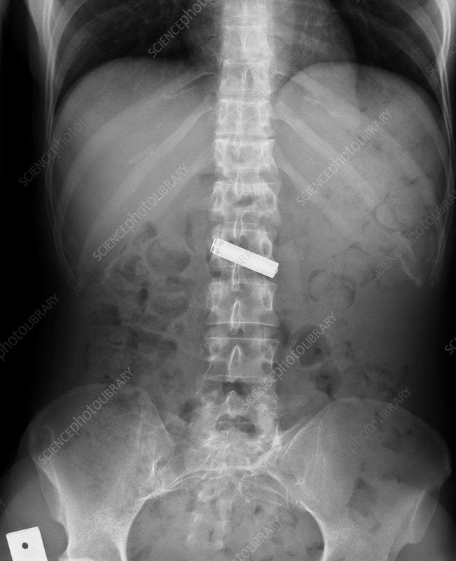 C007594-Swallowed_battery,_X-ray-SPL.jpg