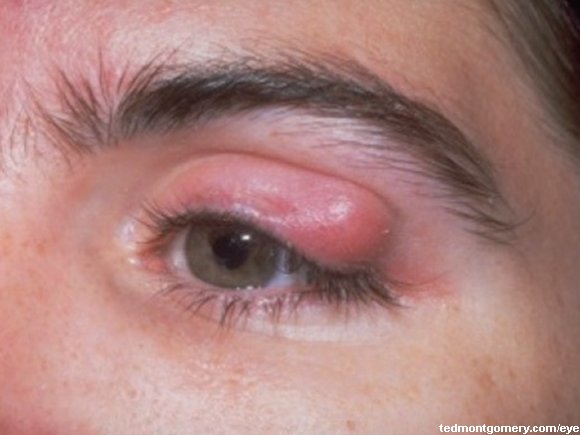 Chalazion.jpg